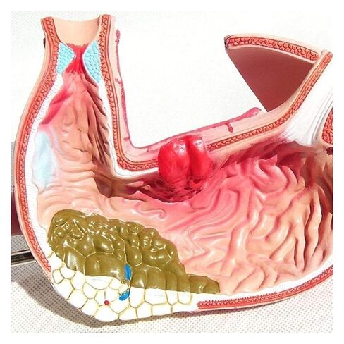 Stomach Disease Anatomical Model, Human, Digestive System Medical in Kuwait