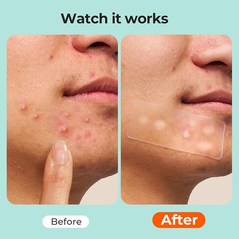 لفة غرواني مائي بحجمين من TKTK، (2 بوصة * 12 قدم + 1 بوصة * 12 قدم) ضمادات غرواني مائي، رقعة غرواني مائي لحب الشباب والجروح والحروق والعناية بالبثور، ورقع البثور مع دعامة سهلة التقشير، مقاومة للماء وفائقة الامتصاص in Kuwait