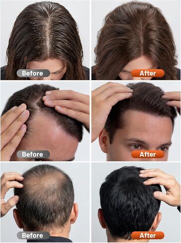 قبعة العلاج بالضوء الأحمر للشعر من ريليكسنو، معالجة بالضوء الأحمر 180 مصباح LED مطورة للرأس، العلاج بالضوء بالأشعة تحت الحمراء للرجال والنساء مع مؤقت وجهاز تحكم (أسود عميق) in Kuwait