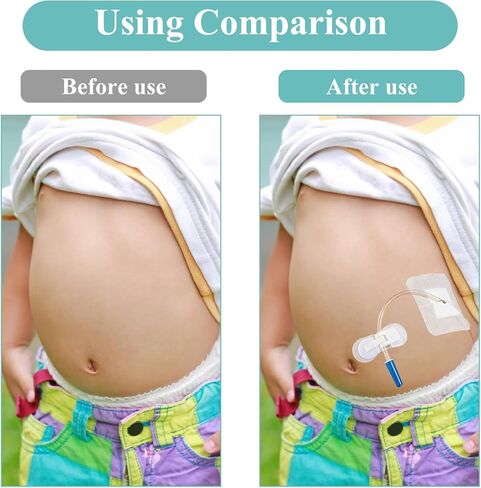 10 عبوات من وسادات أنبوب تغذية القسطرة PD + 10 عبوات من حامل أنبوب التغذية، ضمادات لاصقة مقسمة، أغطية أنبوب G، جهاز تثبيت القسطرة، ضمادة لاصقة ذاتية اللصق، مستلزمات أنبوب التغذية in Kuwait