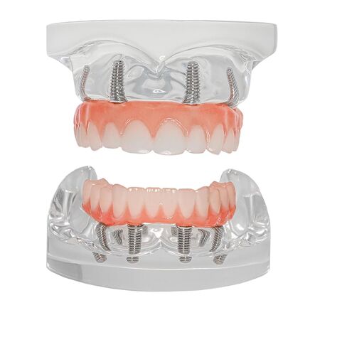Dental Typodont Implant Transparent Model, Upper Lower Jaw Type, Malong Bridge,Removable All-on-4 Restoration Overdenture, with 4 Implants (Typodont Implant Upper+Lower Jaw Kit M6001+6027) in Saudi Arabia