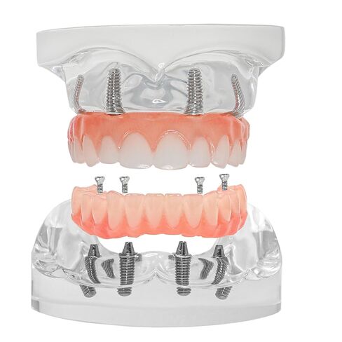 Dental Typodont Implant Transparent Model, Upper Lower Jaw Type, Malong Bridge,Removable All-on-4 Restoration Overdenture, with 4 Implants (Typodont Implant Upper+Lower Jaw Kit M6001+6027) in Saudi Arabia