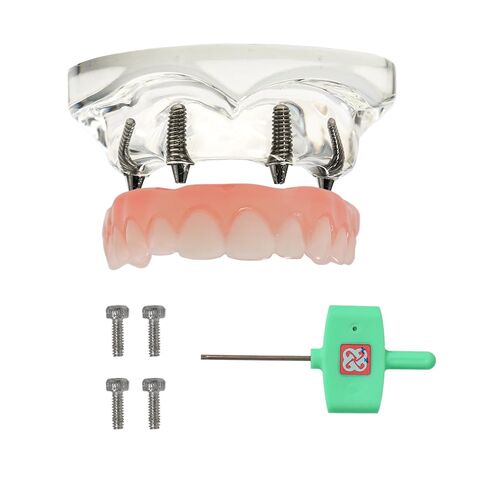 Dental Typodont Implant Transparent Model, Upper Lower Jaw Type, Malong Bridge,Removable All-on-4 Restoration Overdenture, with 4 Implants (Typodont Implant Upper+Lower Jaw Kit M6001+6027) in Saudi Arabia