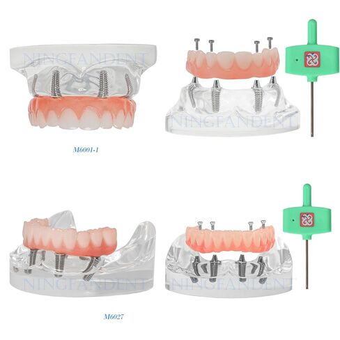Dental Typodont Implant Transparent Model, Upper Lower Jaw Type, Malong Bridge,Removable All-on-4 Restoration Overdenture, with 4 Implants (Typodont Implant Upper+Lower Jaw Kit M6001+6027) in Saudi Arabia