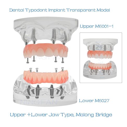 Dental Typodont Implant Transparent Model, Upper Lower Jaw Type, Malong Bridge,Removable All-on-4 Restoration Overdenture, with 4 Implants (Typodont Implant Upper+Lower Jaw Kit M6001+6027) in Saudi Arabia