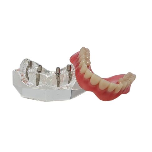 Dental Typodont Implant Transparent Model, Upper Lower Jaw Type, Malong Bridge,Removable All-on-4 Restoration Overdenture, with 4 Implants (Typodont Implant Upper+Lower Jaw Kit M6001+6027) in Saudi Arabia