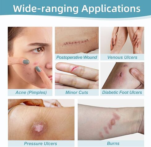 Hydrocolloid Bandages for Wound Care Dressing, 6.6ft Hydrocolloid Roll DIY Size & Shape Hydrocolloid Patch Tape with Self-Adhesive for Burn, Blister, Acne Care (2in x 6.6ft) in Kuwait