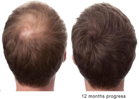 الأصلي النقي الطبيعي X2 العمل البيوتين DHT مانع بيتا سيتوستيرول FL المصدر الطبيعي زيت البلميط البري يمنع ويوقف تساقط الشعر، تقوية الجذور، يعزز تدفق البول، دعم البروستاتا in Kuwait