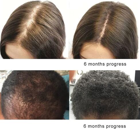 الأصلي النقي الطبيعي X2 العمل البيوتين DHT مانع بيتا سيتوستيرول FL المصدر الطبيعي زيت البلميط البري يمنع ويوقف تساقط الشعر، تقوية الجذور، يعزز تدفق البول، دعم البروستاتا in Kuwait