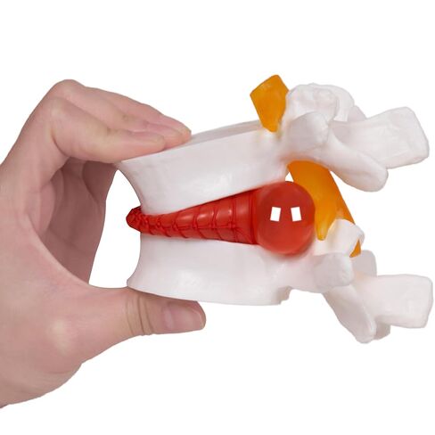 نموذج فتق القرص القطني التشريحي البشري من بريسكي: 1.5 مرة بالحجم الطبيعي للقرص القطني أداة نموذج للتدريس - للعروض الطبية والتعلم والتعليم والعروض العلمية in Kuwait