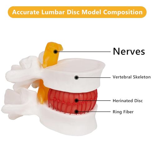 نموذج فتق القرص القطني التشريحي البشري من بريسكي: 1.5 مرة بالحجم الطبيعي للقرص القطني أداة نموذج للتدريس - للعروض الطبية والتعلم والتعليم والعروض العلمية in Kuwait