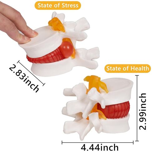 نموذج فتق القرص القطني التشريحي البشري من بريسكي: 1.5 مرة بالحجم الطبيعي للقرص القطني أداة نموذج للتدريس - للعروض الطبية والتعلم والتعليم والعروض العلمية in Kuwait