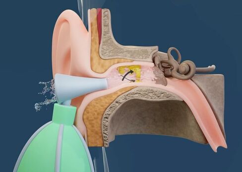 The Swirly-Ear: Ear Wax Removal and Ear Canal Dryer. Otolaryngologist Developed. Non-Invasive, Battery-Free, Safe for Adults and Kids in Saudi Arabia