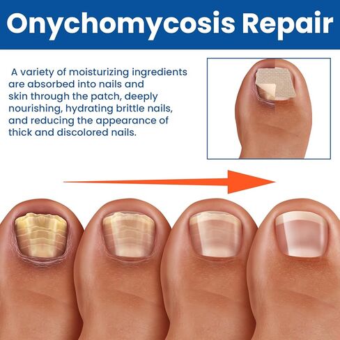 Fungal Nail Patches,60 pcs Toe Nail Fungus Treatments Patches,Nail Fungus Treatment Extra Strength,8-Hour Overnight Nail Treatment Restores Healthy Appearance in Saudi Arabia