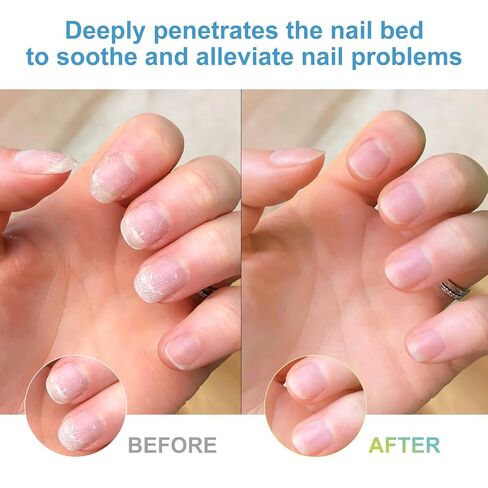 Nail Care Cream,Phrena Toenail Nail Repair for Damaged,Natural Formula with Tea Tree Oil, Oregano Oil,Vitamin E & Allantoin,60ml/2.03fl.oz in Saudi Arabia