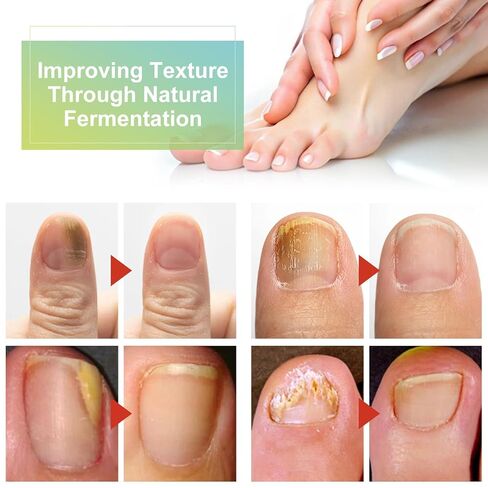 Nail Care Cream,Phrena Toenail Nail Repair for Damaged,Natural Formula with Tea Tree Oil, Oregano Oil,Vitamin E & Allantoin,60ml/2.03fl.oz in Saudi Arabia