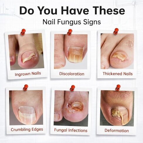 Toenail Fungus Treatment Extra Strength, 1% Tolnaftate Antifungal Fungal Nail Treatment, ToeNail Fungus Treatments For Thick Discolored Brittle Crumbling Nails, 0.51 fl oz (Pack of 1) in Saudi Arabia