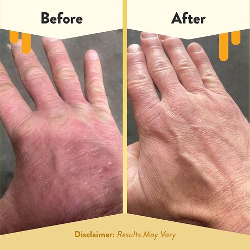 ECZEMA HONEY Gentle Foaming Hand Soap - Gentle Cleanser for Dry Hands - Non-Toxic Unscented Hand Soap - Natural Hand Cleaner for Bathroom & Kitchen - Organic Honey Handwash (8.4 Oz) in Kuwait