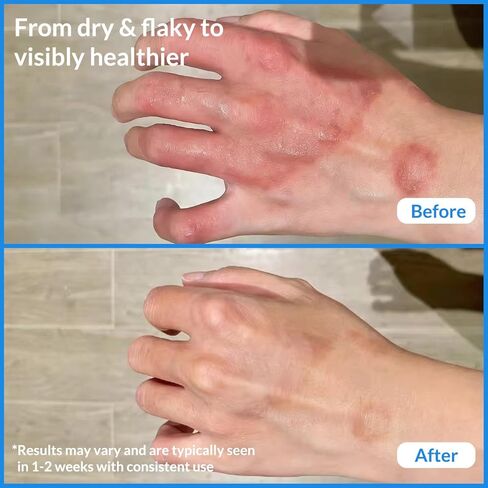 Natural Soothing Eczema Cream - Honey & Sea Moss - Organic Eczema Relief Cream - for Face & Body, Natural Dry Skin Repair (4 oz) in Saudi Arabia