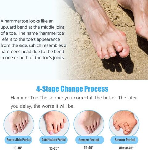 Hammer Toe Straightener Toe Corrector for Women, 8Pcs Toe Support Pads Cushion, Triple Loop Gel Toe Spacers & Separators for Overlapping, Curled, Curved, Claw Toe (White) in Kuwait