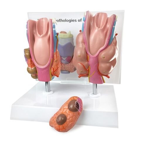 نموذج تشريحي لأمراض الغدة الدرقية البشرية العلمية من إيفوتك - 4 أجزاء بالحجم الطبيعي أداة تعليمية للدراسة الطبية مع حامل ودليل لإظهار تضخم الغدة الدرقية وسرطان الغدة الدرقية ومرض القبور in Kuwait
