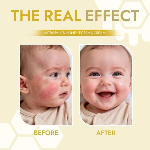 Honey Eczema Soothing Cream for Babies & Kids – Powered by Medical Grade Honey + Colloidal Oatmeal, Steroid-Free Relief for Severe, Itchy, Red, Sensitive Skin, 4 Oz(1pc) in Saudi Arabia
