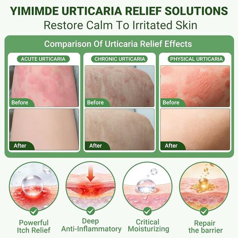 كريم تخفيف الشرى من خلايا النحل، علاج سريع المفعول للطفح الجلدي التحسسي، الأكزيما، حكة الجلد، مركب عضوي عشبي طبيعي، التحكم في الحساسية، 1 أونصة in Kuwait