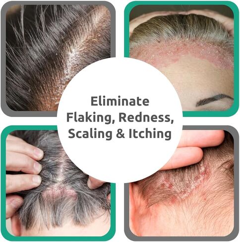 مصل الصدفية لفروة الرأس من دكتور بلين لعلاج الحكة وفروة الرأس المتقشرة | معالجة بحمض الساليسيليك والألانتوين، خالية من العطور والبارابين | تخفيف الصدفية لفروة الرأس الحساسة، حجم السفر 2 أونصة in Kuwait