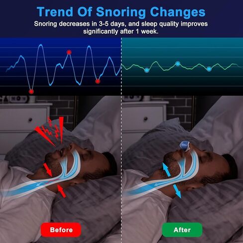 Anti Snoring Devices - Snoring Solution - Mini Anti Snoring Sleep Aid - Upgraded Variable Speed Mini Anti Snoring - Double Eddy Current Nasal Dilators - 2B in Kuwait