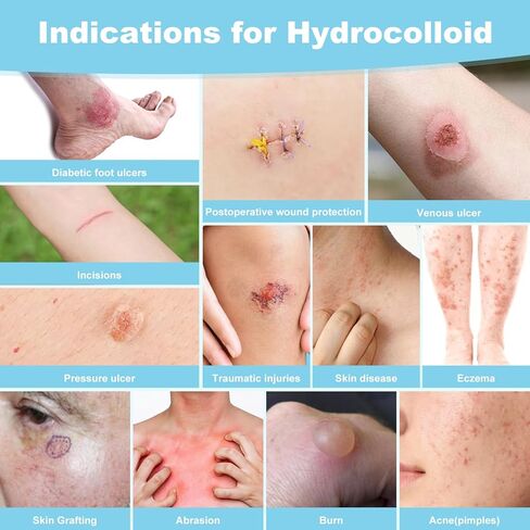 Hydrocolloid Roll Bandages, Extra Long Cut-to-Size Pimple Patch Tape for Face & Body, Ultra Absorbent Large Hydrocolloid Patch for Blister, Burn, Wound Care, Waterproof & Flexible (2in x 5.8ft) in Saudi Arabia