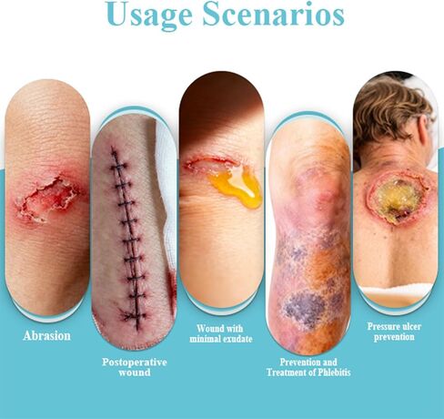 لفة غرواني مائي للعناية بالندبات والجروح (2 بوصة * 16 قدم) - ضمادات غرواني مائي ذاتية اللصق قابلة للتخصيص للإسعافات الأولية والحماية السرية، مقاومة للماء وعالية الامتصاص in Kuwait