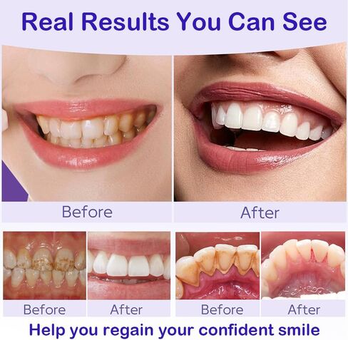 مسحوق تبييض الأسنان مع 20.000 جزء في المليون هيدروكسيباتيت و20.000 جزء في المليون نياسيناميد، مركب إعادة التمعدن R5X الحاصل على براءة اختراع، تبييض الأسنان وإزالة البقع ومعطر التنفس. in Kuwait