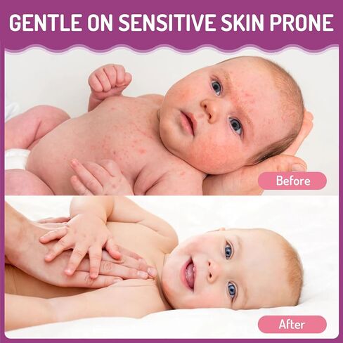 يمنع كريم الشائك | كريم الطفح الجلدي الحراري للأطفال، وطفح العرق، والأكزيما وتهيج الجلد | يهدئ الانزعاج الذي يصيب بشرة الطفل | يعزز إصلاح الحواجز للأطفال | لطيف لحديثي الولادة/الأطفال الصغار - 3.38 أونصة in Kuwait