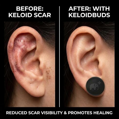 ضغط الجدرة للجُدرات - 4 قطع من مغناطيس الأذن القرنبيط مغطى بالسيليكون المضاد للحساسية - مشبك ضغط الجدرة لدعم تعافي القرنبيط in Kuwait