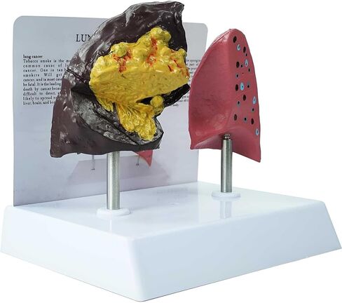 Smoker's Lung vs Healthy Lung Comparative Model - Life Size Anatomical Display for Medical Education, Respiratory Health Study Tool with Pathological Features, PVC Structure in Saudi Arabia