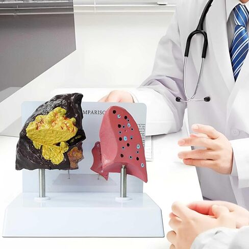 Smoker's Lung vs Healthy Lung Comparative Model - Life Size Anatomical Display for Medical Education, Respiratory Health Study Tool with Pathological Features, PVC Structure in Saudi Arabia