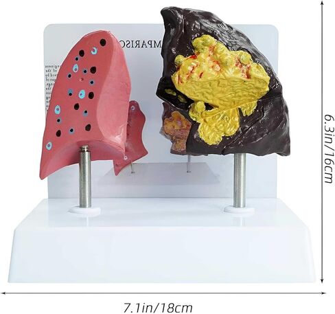 Smoker's Lung vs Healthy Lung Comparative Model - Life Size Anatomical Display for Medical Education, Respiratory Health Study Tool with Pathological Features, PVC Structure in Saudi Arabia