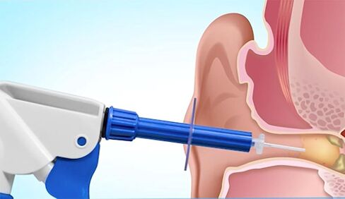 WaxRx Deluxe Ear Wash System, Complete Professional Earwax Removal Kit, Refillable, 3 Complete Uses, with Ear Washer, Basin, Wax Softening Drops, Ear Rinse, Cotton Plugs in Saudi Arabia