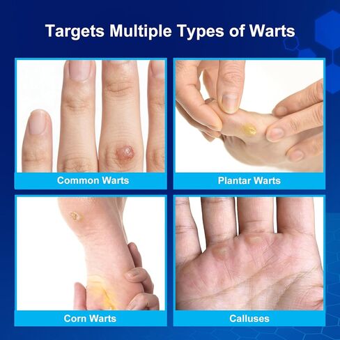 Fast-Acting Wart Remover Freeze Off & Corn Remover, 2-Pack 30 ml Salicylic Acid Plantar Wart Remover for Feet, Hands & Skin - Professional Wart Removal, NDC Code: 76986-024 in Saudi Arabia