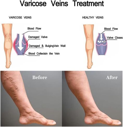 Vericose Veins Treatment Blue Light Lazer Treatment Pen,Spider Vein Treatment for Legs,Varicose Veins Blue Light Therapy Set in Saudi Arabia
