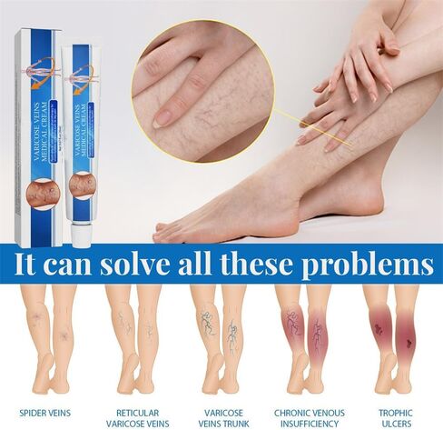 Vericose Veins Treatment Blue Light Lazer Treatment Pen,Spider Vein Treatment for Legs,Varicose Veins Blue Light Therapy Set in Saudi Arabia