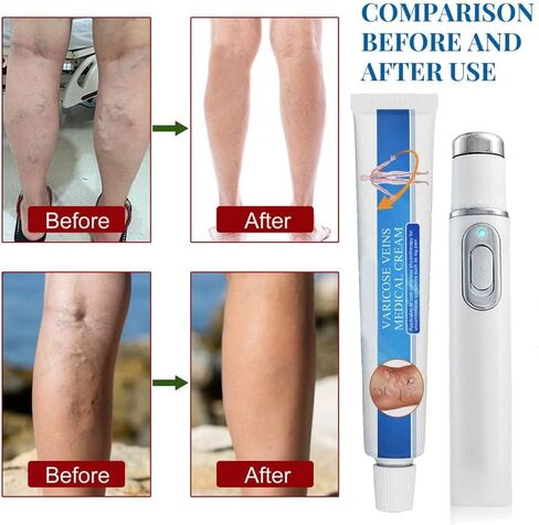 Vericose Veins Treatment Blue Light Lazer Treatment Pen,Spider Vein Treatment for Legs,Varicose Veins Blue Light Therapy Set in Saudi Arabia