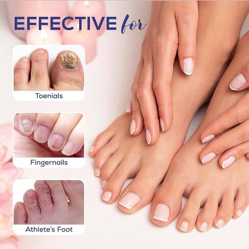 علاج فطريات أظافر القدم من PHARMBANNER قوة إضافية: 25% حمض غير ديسيلينيك لتجديد فطريات الأظافر وأصابع القدم - مجموعة معالجة فطريات الأظافر مع فرشاة ومبرد - للأظافر التي تنمو تحت الجلد وتغير اللون، عبوة من قطعتين in Kuwait