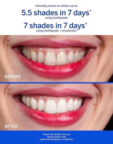 نظام تبييض خالٍ من الفلورايد من Supersmile - معجون أسنان مبيض بدرجة احترافية 3.4 أونصة ومسرع 3.6 أونصة - يبيض ما يصل إلى 6 ظلال ويقوي المينا in Kuwait