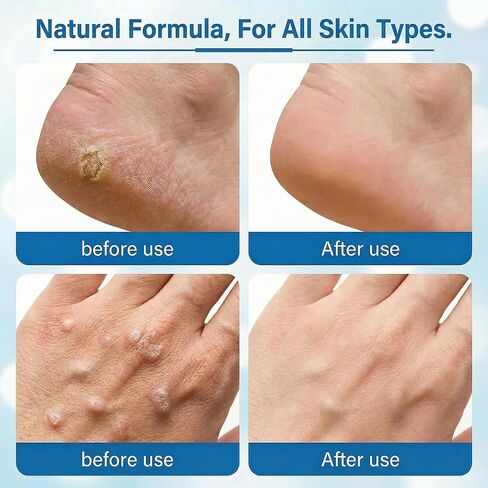 مزيل الثآليل بحمض الساليسيليك بنسبة 17% من هيلموس، كريم احترافي ذو قوة قصوى للثآليل الأخمصية والشائعة والمسطحة، للرجال والنساء - سريع المفعول للقدمين واليدين والجسم، 0.7 أونصة (20 جم) in Kuwait