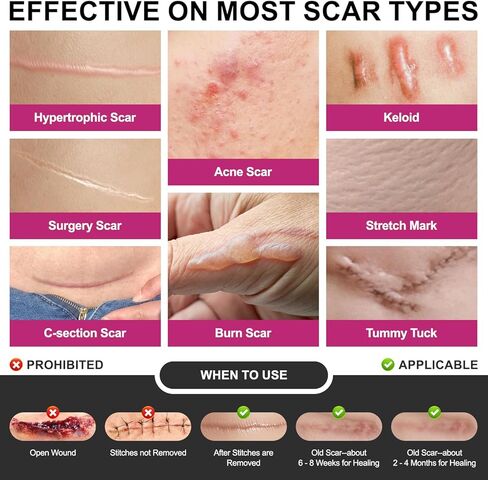 Silicone Scar Sheets Medical Grade Silicone Scar Tape for Surgical Scars 1.77" x 157" 4M Wider Silicone Tape for Keloid Scars, Hypertrophic, C-Section, Tummy Tuck, Surgery and Burn Scar Patches in Kuwait