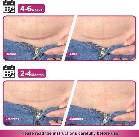 Silicone Scar Sheets Medical Grade Silicone Scar Tape for Surgical Scars 1.77" x 157" 4M Wider Silicone Tape for Keloid Scars, Hypertrophic, C-Section, Tummy Tuck, Surgery and Burn Scar Patches in Kuwait