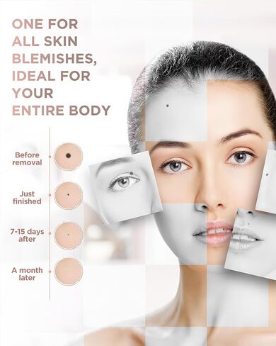 Skin Tag Remover - Skin Tag and Mole Remover for Home Use, Portable Removal Kit for Mole, Wart and Skin Tag for Women and Girls in Kuwait