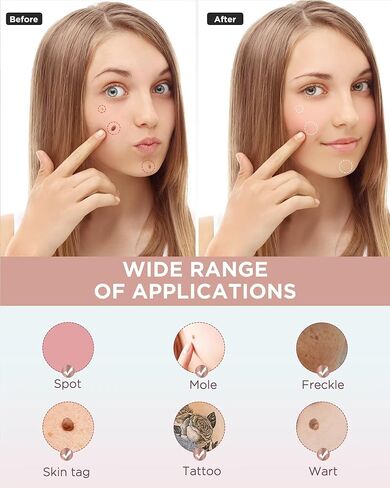 Skin Tag Remover - Skin Tag and Mole Remover for Home Use, Portable Removal Kit for Mole, Wart and Skin Tag for Women and Girls in Kuwait