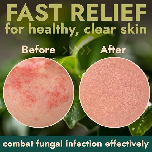 Terramed Just Think Comfort Powerful Antifungal Care Bundle with Tea Tree Oil Spray and Body Wipes for Jock Itch, Athlete’s Foot, Ringworm and Itchy Skin Relief in Kuwait